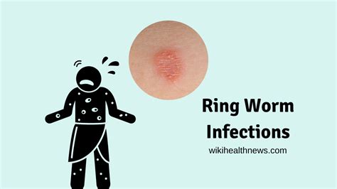 Ring Worm Infection Prevention Treatment Wiki Health News