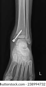 Xray Image Showing Medial Malleolus Fracture Stock Photo 2389947325 ...