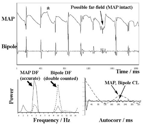 Figure From Dynamics Factors Preceding The Initiation Of Atrial