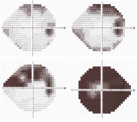 Le glaucome GCAO symptômes diagnostic et traitement