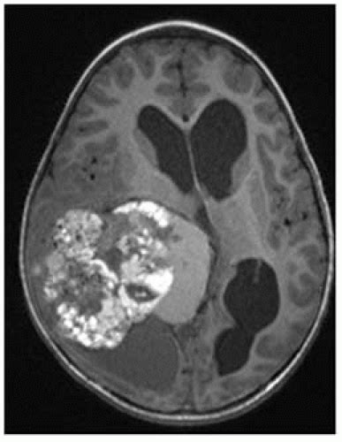 Vascular Malformations Radiology Key