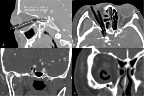 Carotid Ct Angiography A Sagittal Image Showing The Foreign Body Download Scientific Diagram