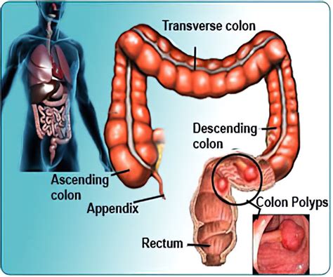 Intestinal Polyps Symptoms