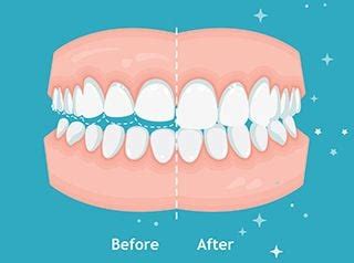 Bruxism | Grand Junction Dentist