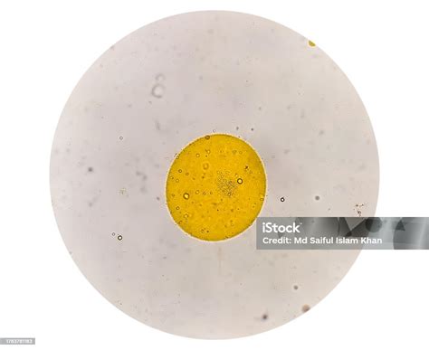 Microscopic View Of Stool Analysis Showing Neutral Fat Fecal Fat ...