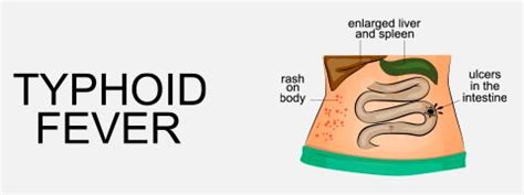 Typhoid: Causes, Symptoms And Treatment | Netmeds