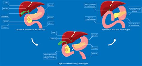 Whipple's — Hepatobiliary & Upper Gastrointestinal Surgery