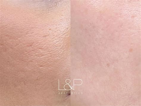 Microneedling Before And After Landp Aesthetics