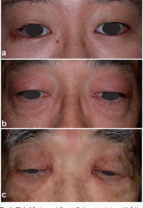 Figure 1 From Eyelid Dermatitis As A Side Effect Of Interleukin 17a