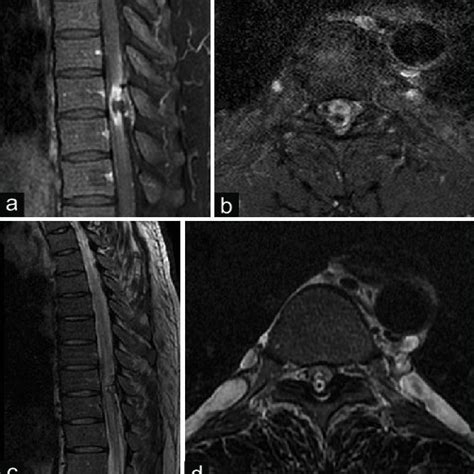 Gadolinium Enhanced T1 Weighted Sagittal A And Axial B Magnetic