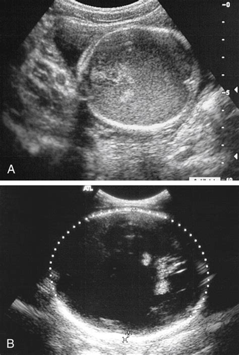 Hydranencephaly Ultrasound