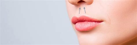 Dudak Kald Rma Lip Lift Do Dr Cem Bayraktar Burun Esteti I