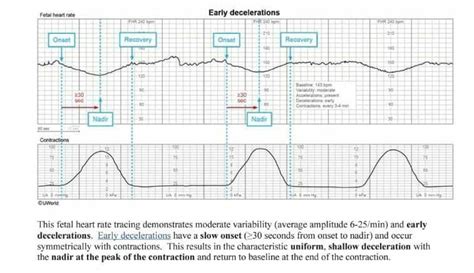 Fetal Heart Rate Early Decelerations The Onso