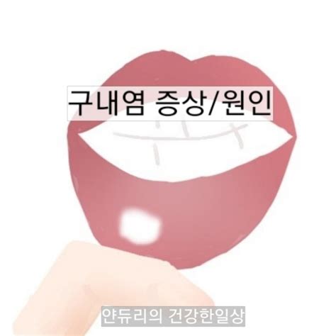 구내염 증상원인 빨리 낫는법 네이버 블로그