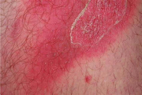 Multiple Sterile Pustules On Erythematous Background Download