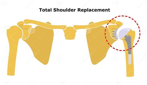 Substituição Total Do Ombro Endopróteses De Substituição Da