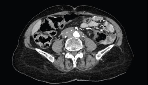 Retroperitoneal Fibrosis