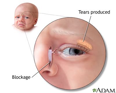 Blocked tear duct | UF Health, University of Florida Health