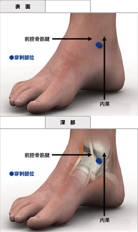 関節穿刺：足関節 Procedures Consult