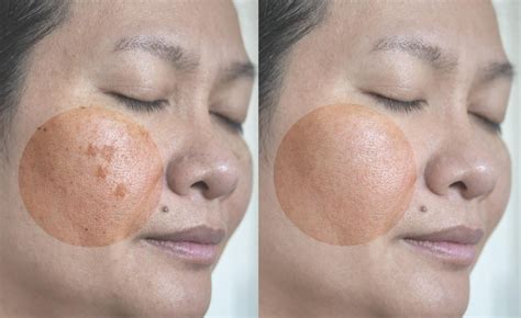 Melasma Síntomas Causas Y Tratamiento Blog Doctorgo