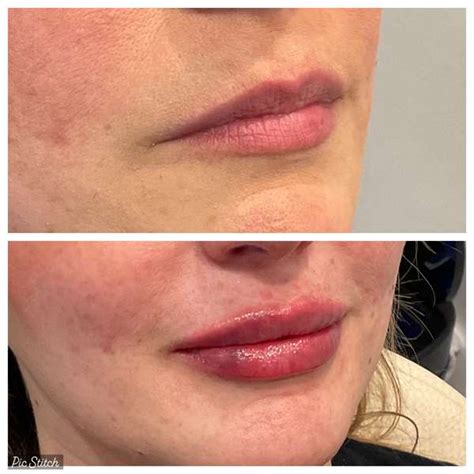 Injectables Before And After Zo Skin Centre Houston