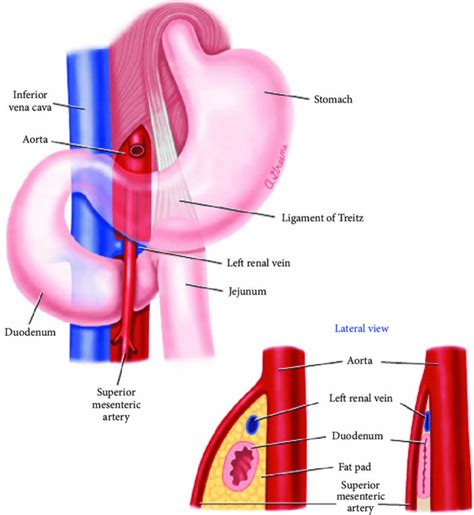 SMA syndrome causes, symptoms, diagnosis, treatment & prognosis