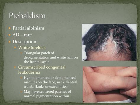 Ppt Disorders Of Pigmentation Powerpoint Presentation Free Download