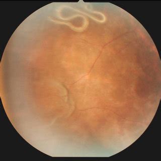 PDF Subretinal Angiostrongyliasis Induced Optic Neuritis