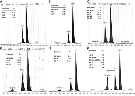 Thalassemia And Hemoglobinopathies In Southeast Asian Newborns Diagnostic Assessment Using