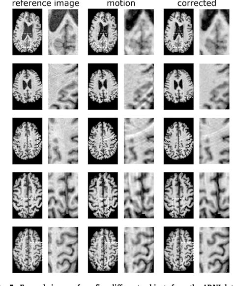 Figure 5 From Retrospective Motion Artifact Correction Of Structural