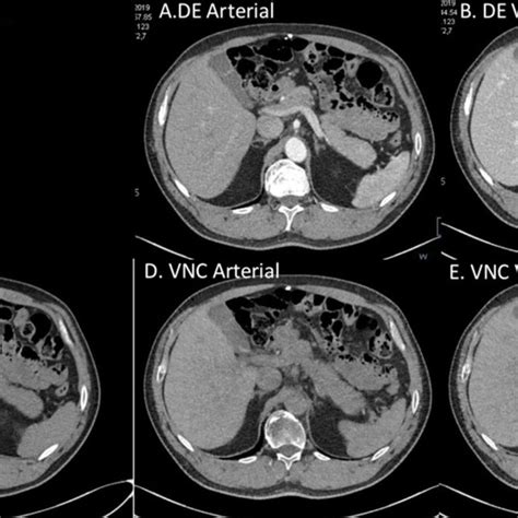 Pdf Virtual Non Contrast With Dual Energy Dual Source Ct In Abdominal Imaging Comparison With