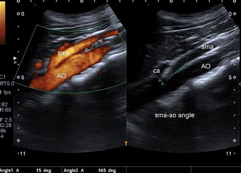 Nutcracker Syndrome Ultrasound