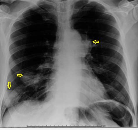 Figure From A Rare Case Of Pulmonary Mucosa Associated Lymphoid