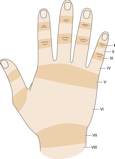 Extensor Tendon Injuries Musculoskeletal Key