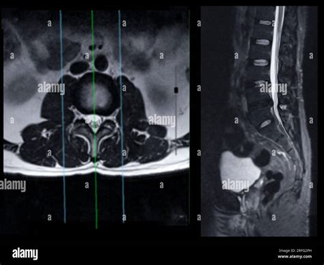 Mri L S Spine Or Lumbar Spine Axial T W View With Sagittal Plane For