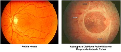 Retinopatía Diabética Clínica De Ojos Oprece