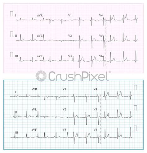 Heart Cardiogram Chart Vector Set Healthy Heart Rhythm Ischemia