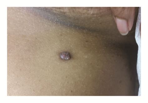 A Supernumerary Nipple‐like Clinical Presentation Of Lymphangioma