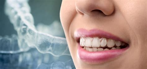 Important Things You Need To Know Before Getting Invisalign