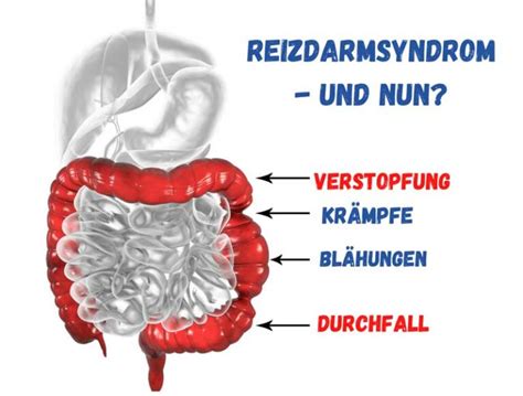 Reizdarmsyndrom Welche Ursachen Gibt Es Was Hilft