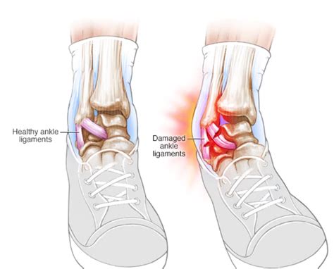 Ankle Sprain — Phila Massages