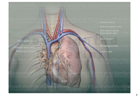 CASE AT A GLANCE: Chemo Port Placement Venous Access — Illustrated Verdict