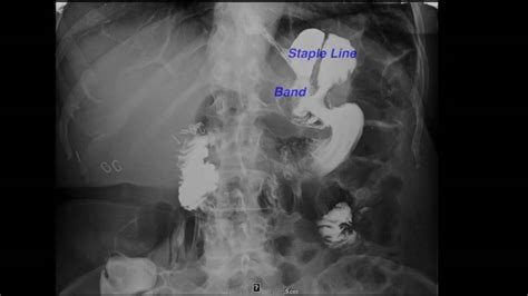 Laparoscopic reversal of vertical banded gastroplasty - American ...