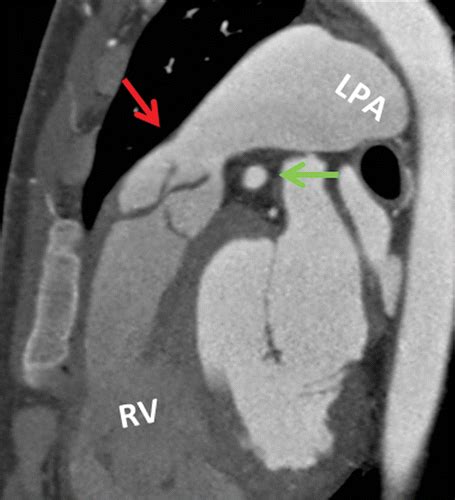 Ct And Mr Imaging Of The Pulmonary Valve Radiographics