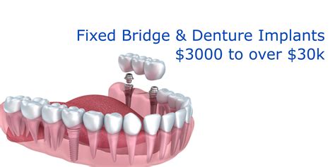 Dental Implant Cost Cost Breakdown Of Dental Implants In Canada