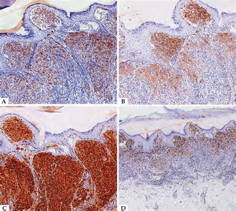 SciELO Brasil Amelanotic Acral Melanoma Misdiagnosed As Verruca