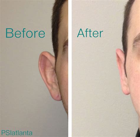 Otoplasty Before After