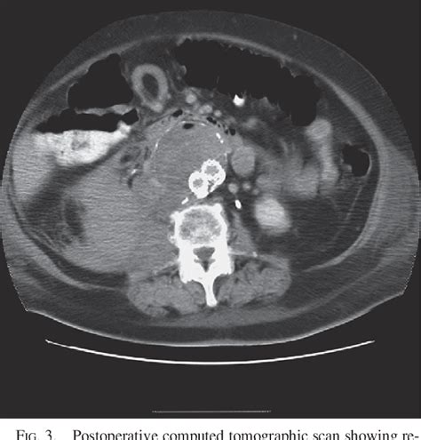 Figure From Endovascular Repair Of Ruptured Abdominal Aortic