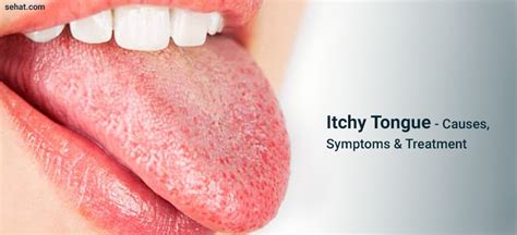 Itchy Tongue - Causes, Symptoms, Remedies & Treatment