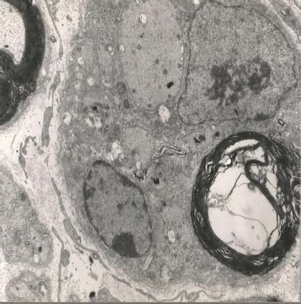 Sciatic Nerve With Syncytium Of Schwann Cells With Degenerate Myelin